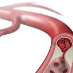 Arteriosklerosis