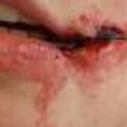 Wunde am Mund