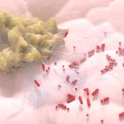 Neutrophile extrazellulare Fallen