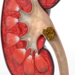3D-Animation UROMED NEPHROquick Ballon-Katheter-Set