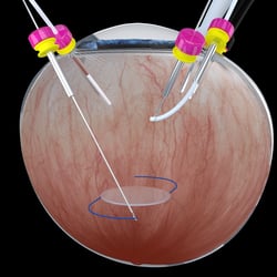 Augen-OP IOL multifocal