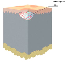 Haut Effloreszenzen Quaddel 3D Block