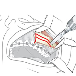 Operation Oberkiefer (Maxilla)