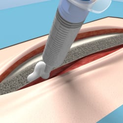 Representation of hemostasis, wound healing and sternotomy for Gelita Medical.