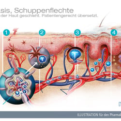 Psoriasis, Schuppenflechte, Immunsystem