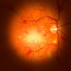 Virtual Reality App zu Erkrankung des Auges durch Diabetes