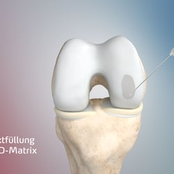 Anatomievisualisierung: Defektfüllung mit 3D-Matrix
