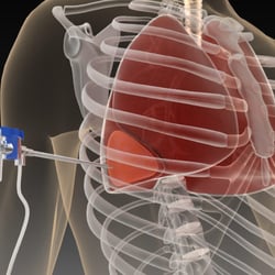 3D Visualisierung: Allomed Medizintechnik Pleurasafe