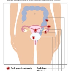 sk-grafik endometriose
