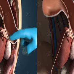 Stereoskopischer 3D Film zu Prostatakrebs