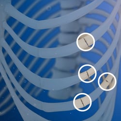 MedXpert STRACOS 3D‑Rippenklammer 3D-Animation Intro