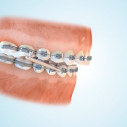Zahnmedizin Bio Bite_Correktor