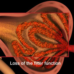 3D Animation zur Erklärung von Nierenversagen Glomerulosklerose