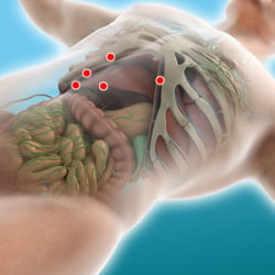 3D Animation zu einer Ösophagektomie-Operation
