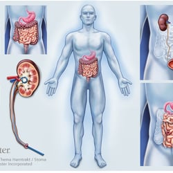 Blase, Darm, Niere, Stoma 1