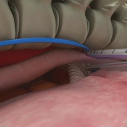 Video zur Patienteninformation zu einer Operation