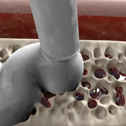 Representation of hemostasis, wound healing and sternotomy for Gelita Medical.