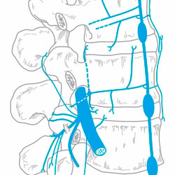 Minimalinvasive Wirbelsäulen Intervention 01