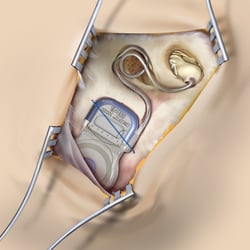 „Single Stich“- Befestigungsmethode des Implantats