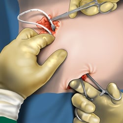 Port-Implantation