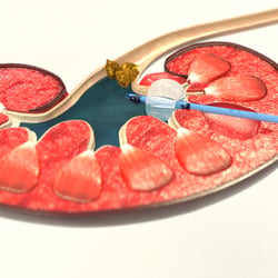 3D-Animation UROMED NEPHROquick Ballon-Katheter-Set