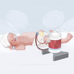 „Perinatal Life Support System“  Illustration für das CVE der RWTH-Aachen