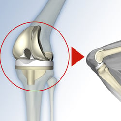 Knie-Endoprothese
