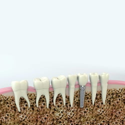3D Visualisation eines Zahnimplantats mit Querschnitt des Zahnfleisches.