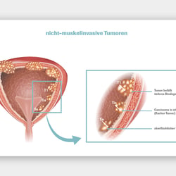 Blasenkrebs Illustrationen