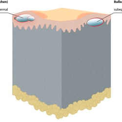 Haut Effloreszenzen Blasen 3D Block