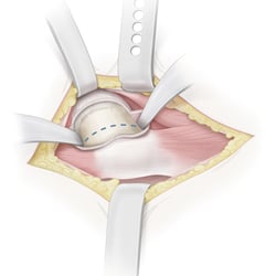THA, antolateral approach