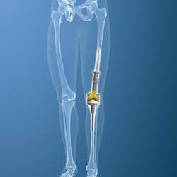 Distaler Femurersatz Tibia