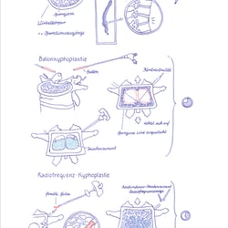 Kyphoplastie