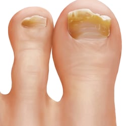 Nagelpilz